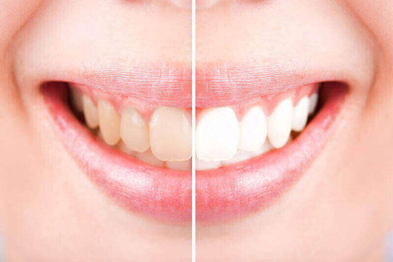 Teeth Whitening Orléans